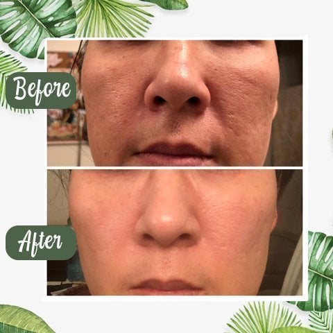 Anti Mee-eter & Acne Gezichtsmasker