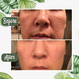 Anti Mee-eter & Acne Gezichtsmasker