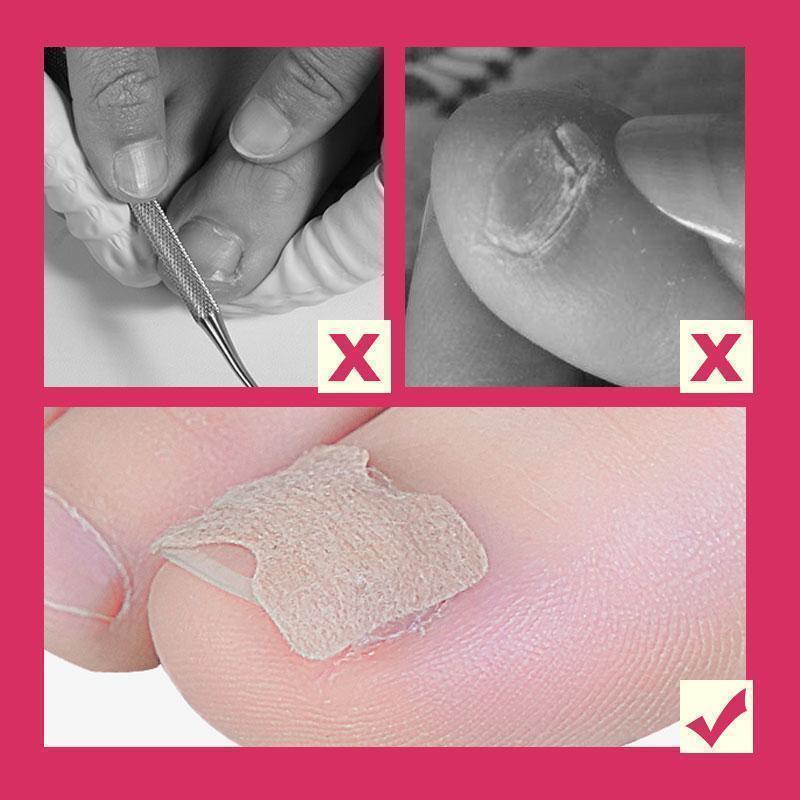 Anti-Ingroei Nagel Stikkers (Tijdelijk 50% Korting!)