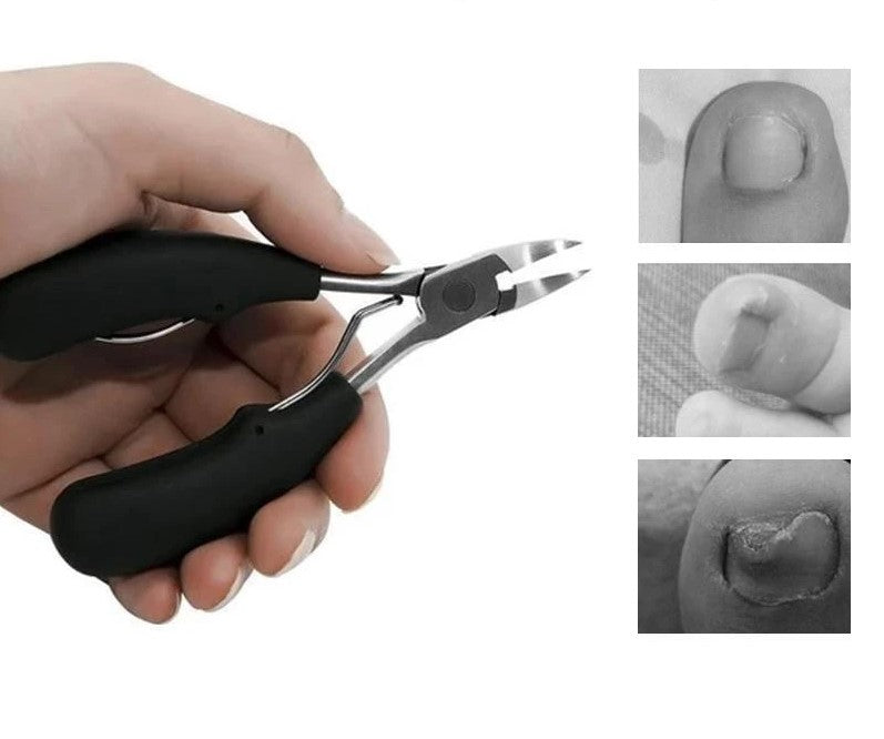 Professioneel Teennagel Schaartje™ | Ook tegen Ingegroeide Teennagels!