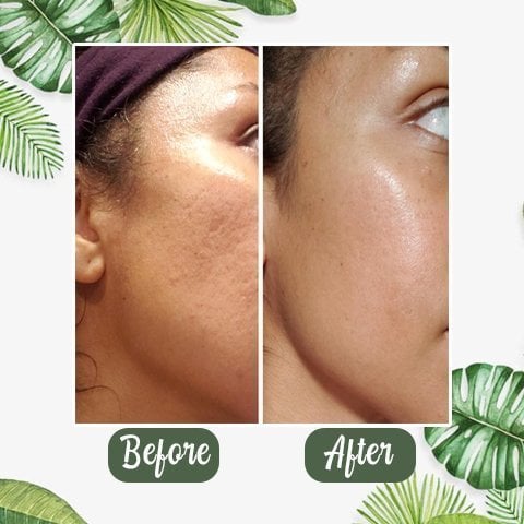 Anti Mee-eter & Acne Gezichtsmasker
